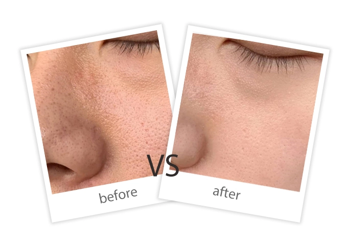 Facial Treatment-13