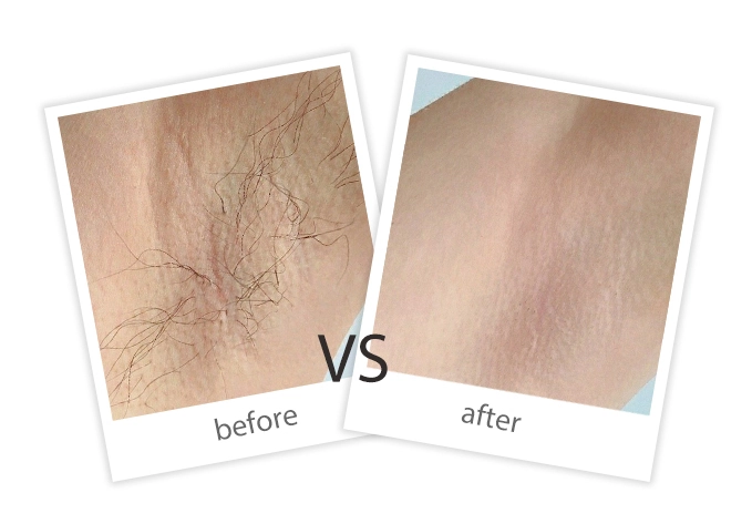 Hair Removal-10