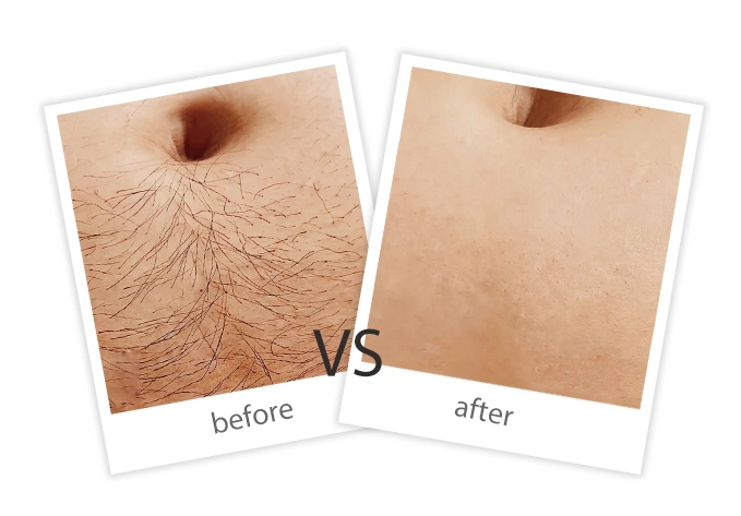Hair Removal-5