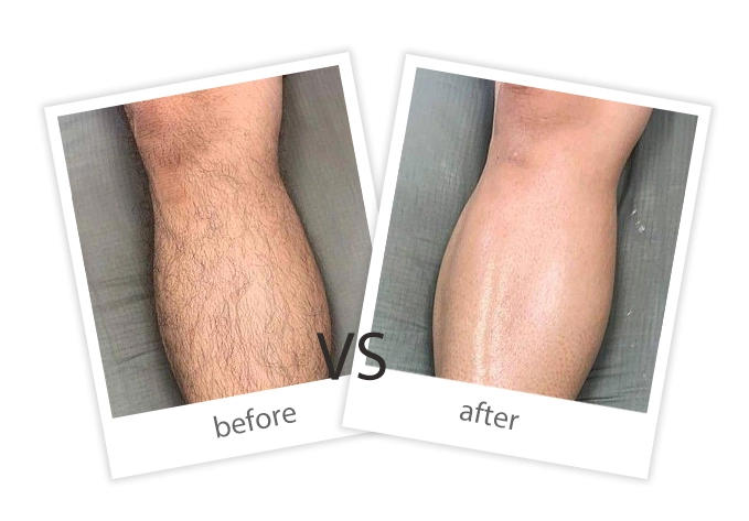 Hair Removal-8