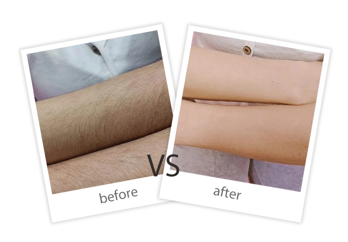 Hair Removal-9