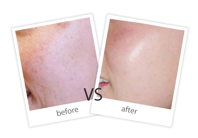 Pigment Removal-5