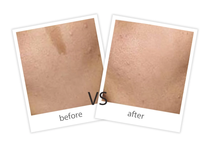 Pigment Removal-6