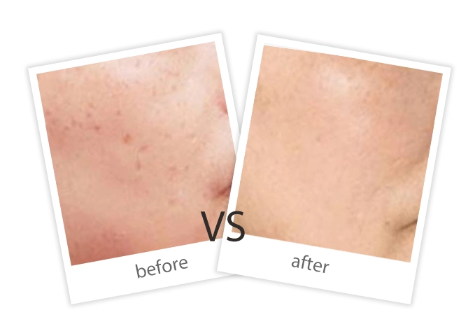 Pigment Removal-7