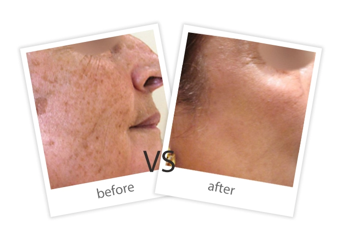 Pigment Removal-8