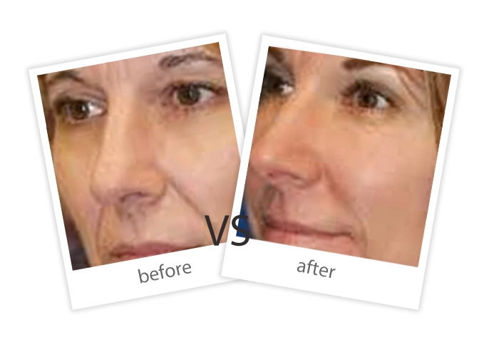 Skin Rejuvenation-6
