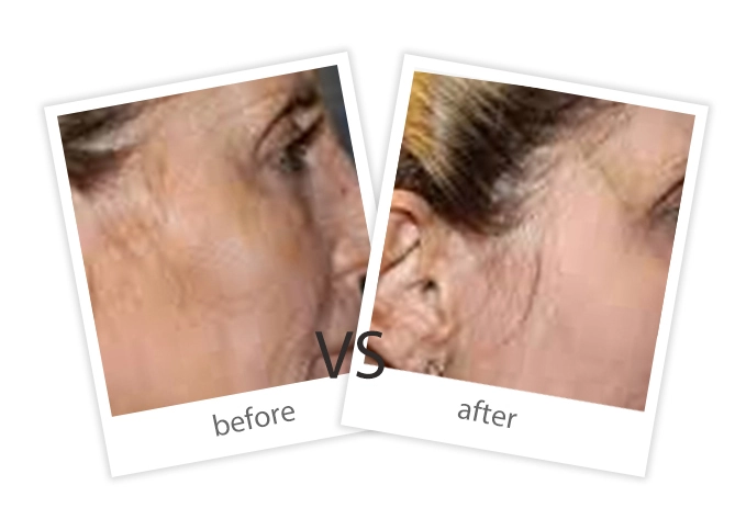 Skin Rejuvenation-8