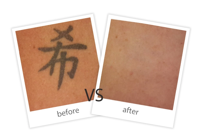 Tattoo Removal-5