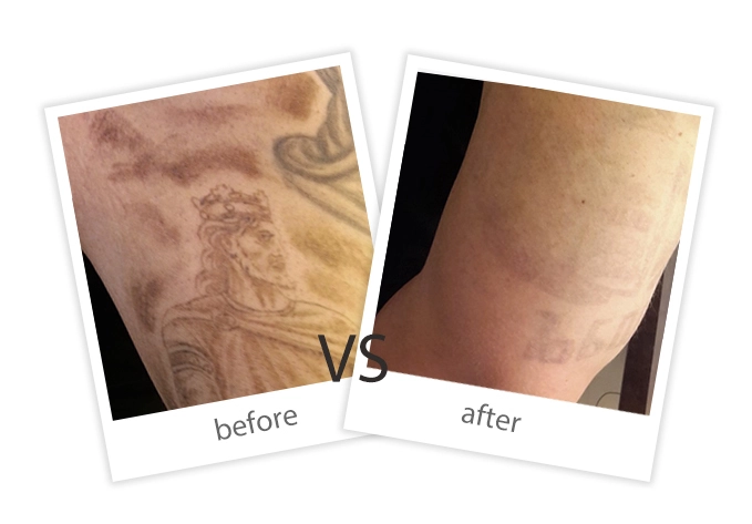 Tattoo Removal-6