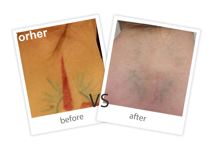 Tattoo Removal-7