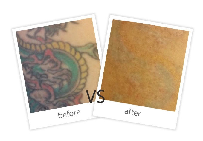 Tattoo Removal-8