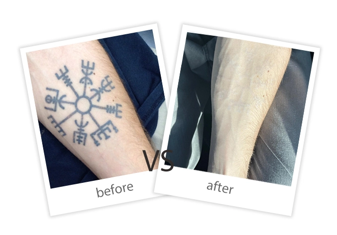 Tattoo Removal-9